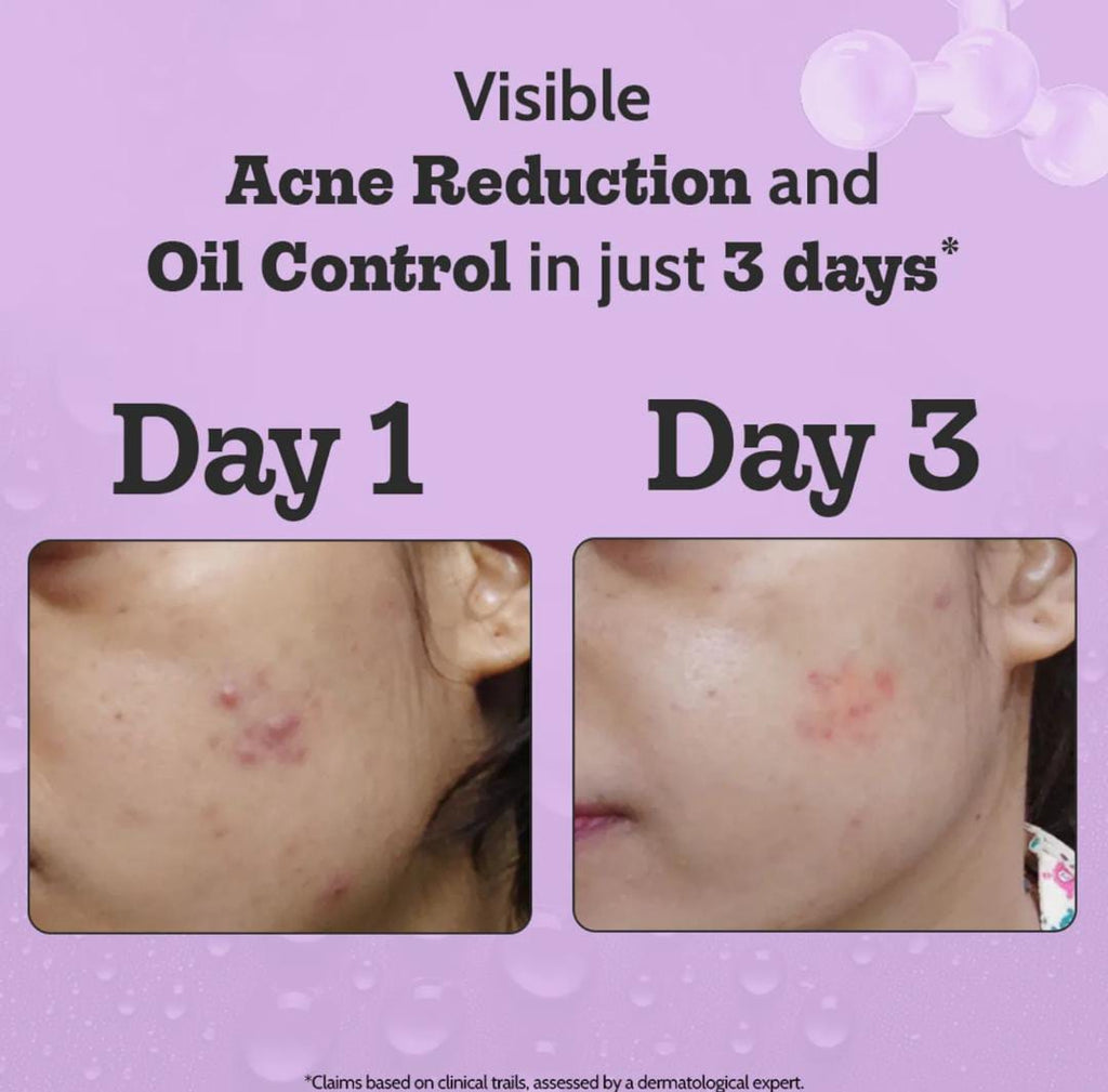 Chemist at Play. Face Serum Treats Active Acne, Controls Excess Oil | 30ml