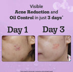 Chemist at Play. Face Serum Treats Active Acne, Controls Excess Oil | 30ml