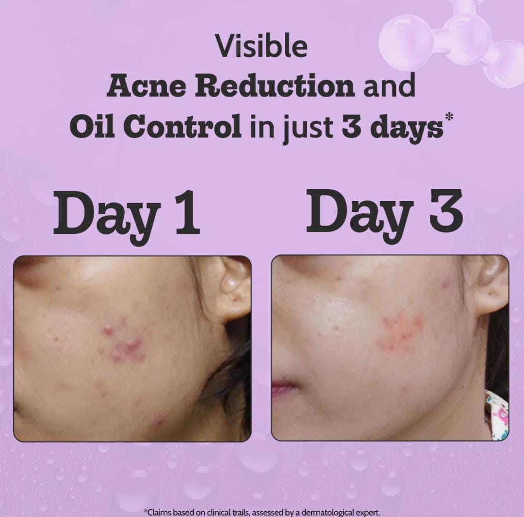 Chemist at Play. Face Serum Treats Active Acne, Controls Excess Oil | 30ml