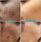 Pilgrim. 10% Niacinamide Face Serum For Acne Marks | 30ml | #PS189