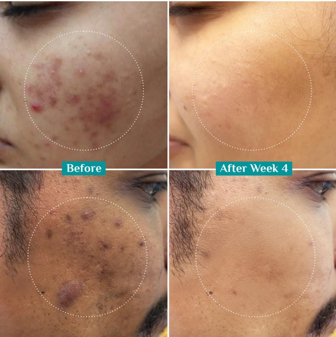 Pilgrim. 10% Niacinamide Face Serum For Acne Marks | 30ml | #PS189